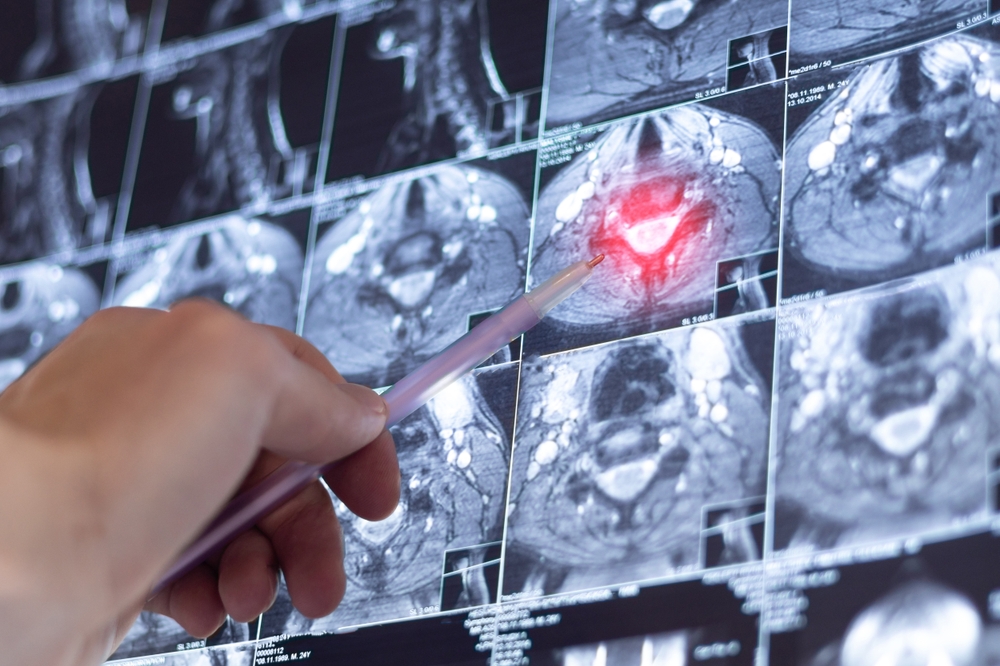 Pet treatment for head and neck cancer can help humans