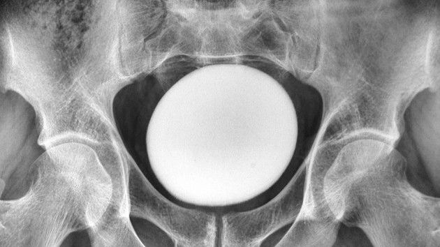 Diagnostic dilemma: Huge ‘stone’ in man’s bladder looked like an ostrich egg